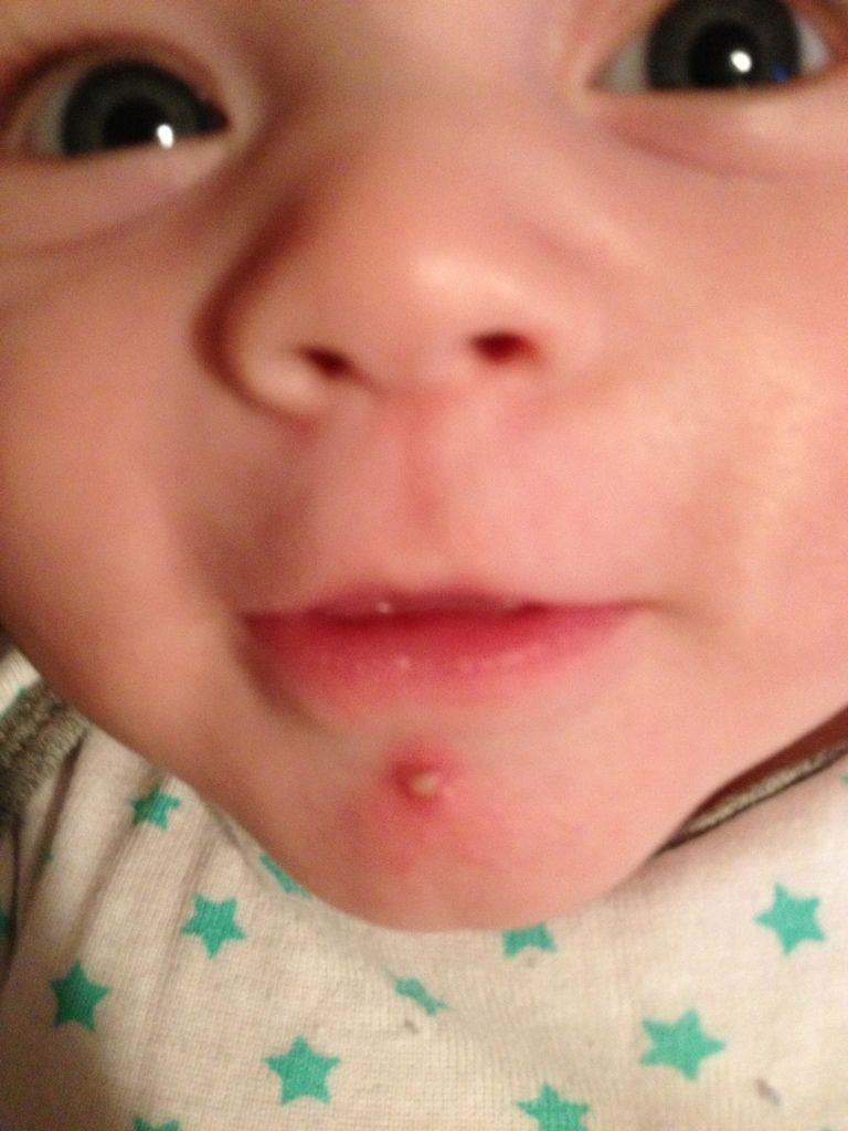 baby-with-a-pimple-pic-babycenter