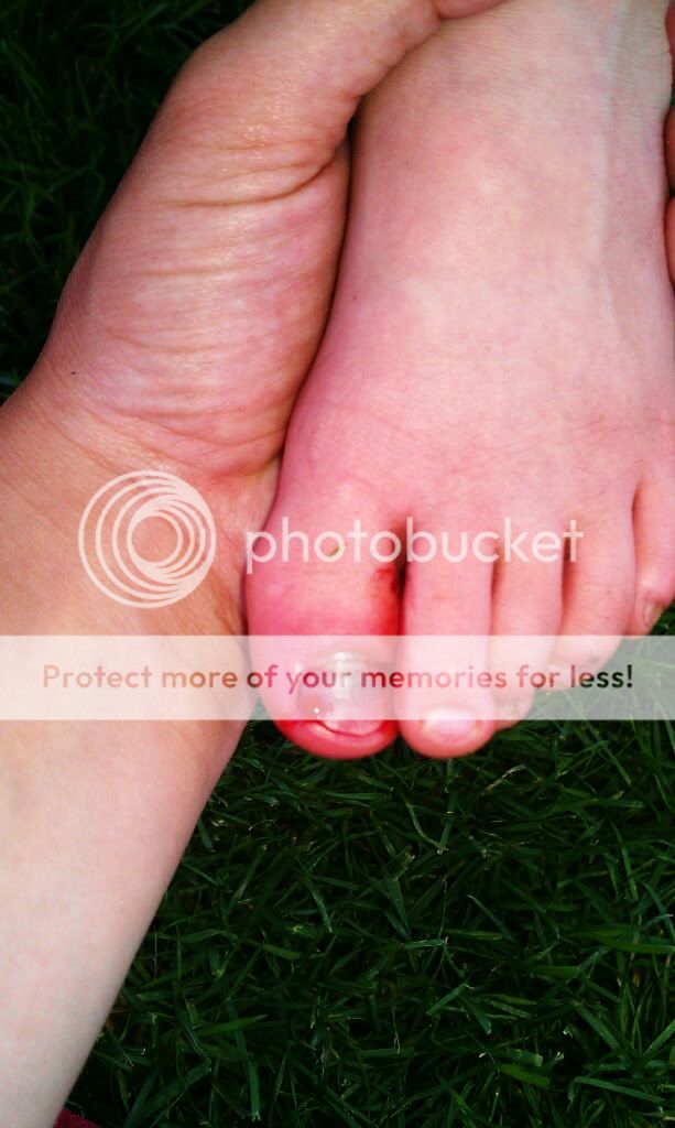 ot-what-to-do-if-a-toenail-falls-off-images-included-babycenter